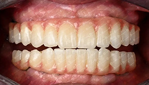 mais recente caso da empresa sobre Caso do cliente. Bloco de zircônio 4D.