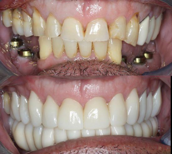 Yucera 4D Pro Dental - Bloco de Cerâmica de Zircônia Específico com Tecnologia HT Plus Melhorando a Qualidade das Restaurações