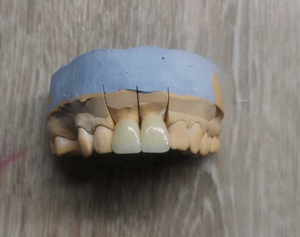 Descubra a Versatilidade das Placas de Zircônia ST Color Yucera para Coroas e Pontes Dentárias